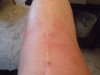 [Bonesmart.org] TKR problems after 6 years