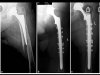 [Bonesmart.org] 'Fractured Neck of Femur/Pinning - Broke hip 5 weeks after replacement'