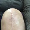 [Bonesmart.org] Knee Scars - Post Your Badges of Honor Here! NO CHIT-CHAT please