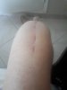 [Bonesmart.org] One Year Post Surgery