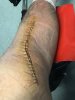 [Bonesmart.org] Knee Scars - Post Your Badges of Honor Here! NO CHIT-CHAT please