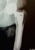 [Bonesmart.org] 8wks post op - more pain than before<<