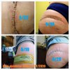 [Bonesmart.org] Hippies scars - post your badges of honor here: NO CHIT-CHAT HERE PLEASE