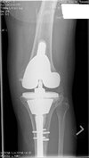 [Bonesmart.org] My new knee