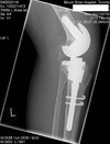 [Bonesmart.org] My new knee