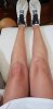 [Bonesmart.org] One Year Post Surgery