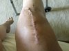 [Bonesmart.org] Knee Scars - Post Your Badges of Honor Here! NO CHIT-CHAT please