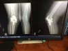 [Bonesmart.org] Knee Scars - Post Your Badges of Honor Here! NO CHIT-CHAT please
