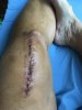 [Bonesmart.org] So I did it. Jiffy knee!