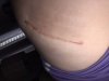 [Bonesmart.org] Hippies scars - post your badges of honor here: NO CHIT-CHAT HERE PLEASE
