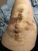 [Bonesmart.org] SpaceGirls Road to Recovery Knee #2