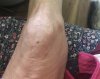 [Bonesmart.org] Knee Scars - Post Your Badges of Honor Here! NO CHIT-CHAT please