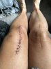 [Bonesmart.org] So I did it. Jiffy knee!