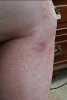 [Bonesmart.org] Allin1's left knee TKR