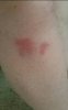 [Bonesmart.org] Allin1's left knee TKR