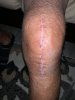 [Bonesmart.org] Knee Scars - Post Your Badges of Honor Here! NO CHIT-CHAT please