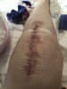 [Bonesmart.org] Knee Scars - Post Your Badges of Honor Here! NO CHIT-CHAT please