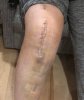[Bonesmart.org] Knee Scars - Post Your Badges of Honor Here! NO CHIT-CHAT please