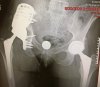 [Bonesmart.org] LLD Due to Pelvic Tilt