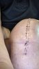 [Bonesmart.org] Knee Scars - Post Your Badges of Honor Here! NO CHIT-CHAT please