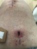 [Bonesmart.org] _Annie_‘s Recovery Thread