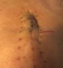 [Bonesmart.org] _Annie_‘s Recovery Thread