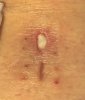 [Bonesmart.org] _Annie_‘s Recovery Thread