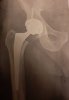 [Bonesmart.org] Hippies scars - post your badges of honor here: NO CHIT-CHAT HERE PLEASE