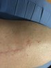 [Bonesmart.org] 3 years post op