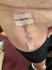 [Bonesmart.org] I am now bionic