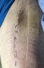 [Bonesmart.org] Hippies scars - post your badges of honor here: NO CHIT-CHAT HERE PLEASE