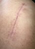 [Bonesmart.org] Hippies scars - post your badges of honor here: NO CHIT-CHAT HERE PLEASE