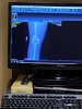 [Bonesmart.org] It’s Done! From Revision to Tibial Tubercle Osteotomy