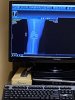 [Bonesmart.org] It’s Done! From Revision to Tibial Tubercle Osteotomy