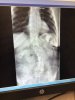 Scoliosis Spine.jpg