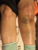 [Bonesmart.org] Knee Scars - Post Your Badges of Honor Here! NO CHIT-CHAT please