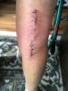 [Bonesmart.org] Knee Scars - Post Your Badges of Honor Here! NO CHIT-CHAT please