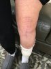 [Bonesmart.org] Knee Scars - Post Your Badges of Honor Here! NO CHIT-CHAT please