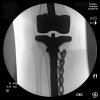 [Bonesmart.org] Lovetocookandsew’s long road to recovery