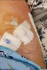 [Bonesmart.org] Lovetocookandsew’s long road to recovery