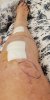 [Bonesmart.org] Lovetocookandsew’s long road to recovery