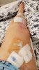 [Bonesmart.org] Lovetocookandsew’s long road to recovery