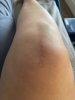 [Bonesmart.org] Knee Scars - Post Your Badges of Honor Here! NO CHIT-CHAT please