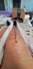 [Bonesmart.org] Knee Scars - Post Your Badges of Honor Here! NO CHIT-CHAT please