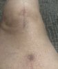 [Bonesmart.org] _Annie_‘s Recovery Thread