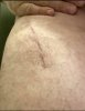 [Bonesmart.org] Hippies scars - post your badges of honor here: NO CHIT-CHAT HERE PLEASE