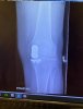 [Bonesmart.org] PartialFix -- Recovering...