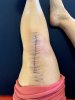 [Bonesmart.org] Knee Scars - Post Your Badges of Honor Here! NO CHIT-CHAT please