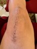 [Bonesmart.org] Knee Scars - Post Your Badges of Honor Here! NO CHIT-CHAT please