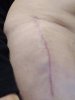 [Bonesmart.org] Sheila-Seattle's Recovery Story
